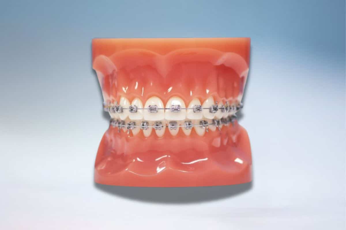 Hentscher johnson orthodontic metal self ligating braces 3