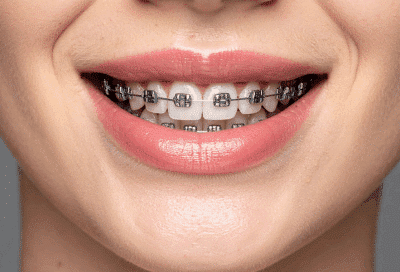 Close-up of a female wearing braces on her teeth, representing evolution of braces