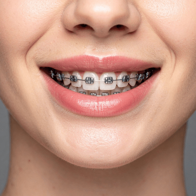 Close-up of a female wearing braces on her teeth, representing evolution of braces